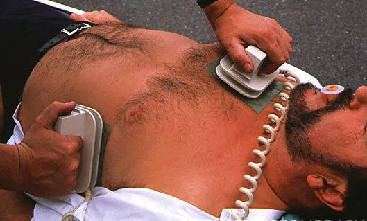 Τοποθέτηση ηλεκτροδίων απινίδωσης στον θώρακα