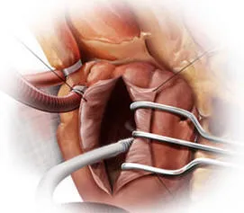 Cryoablation Illustration