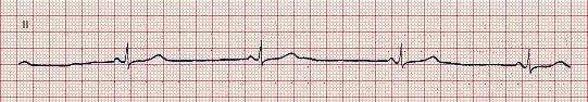 ECG Sinus Bradycardia