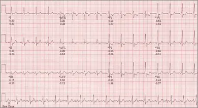 WPW ECG Triad