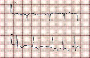 Κολπική Μαρμαρυγή
