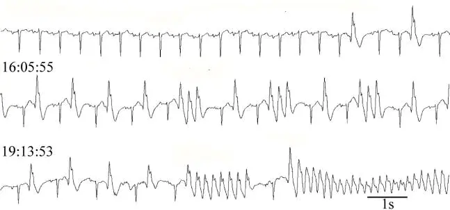ECG: PVCs and VT
