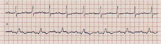Ηλεκτροκαρδιογράφημα κολποκοιλιακού αποκλεισμού πρώτου βαθμού