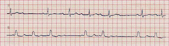 Ηλεκτροκαρδιογράφημα κολποκοιλιακού αποκλεισμού δεύτερου βαθμού