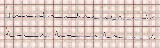 Ηλεκτροκαρδιογράφημα πλήρους κολποκοιλιακού αποκλεισμού τρίτου βαθμού