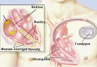 Σύστημα Βηματοδότη