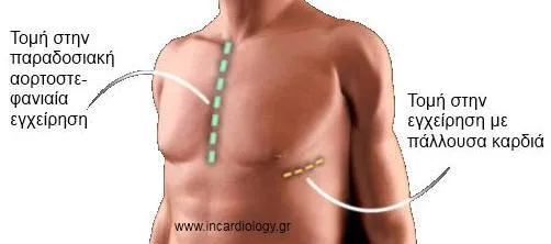 Αορτοστεφανιαία παράκαμψη σε πάλλουσα καρδιά