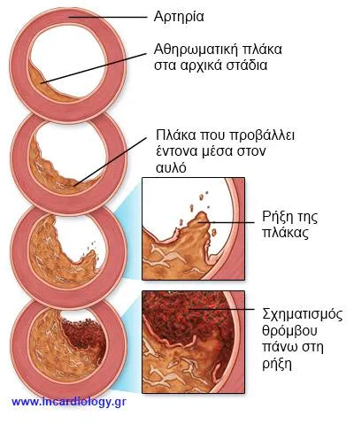 Αθηροσκλήρωση και θρόμβος σε στεφανιαία αρτηρία