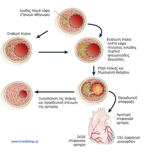 Σταθερή και ασταθής αθηρωματική πλάκα