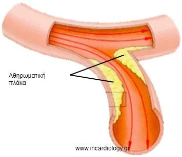 Ρήξη αθηρωματικής πλάκας και σχηματισμός θρόμβου