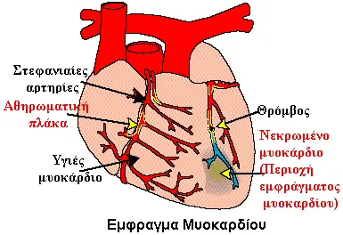 Αναπαράσταση Εμφράγματος