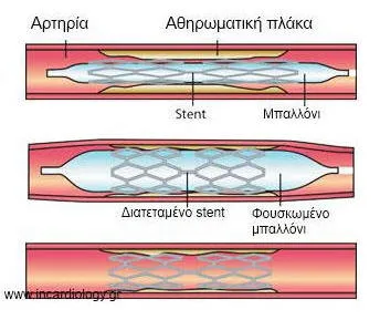 Stent τοποθετημένο μέσα σε αθηρωματική πλάκα