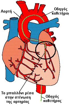 Καθετήρας αγγειοπλαστικής μέσα σε στεφανιαία αρτηρία