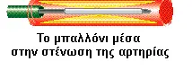 Διάταση στεφανιαίας στένωσης με μπαλονάκι