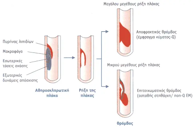Θρόμβωση στεφανιαίας αρτηρίας μετά από ρήξη πλάκας