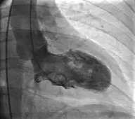 Πρώιμες αλλοιώσεις του τοιχώματος της στεφανιαίας αρτηρίας