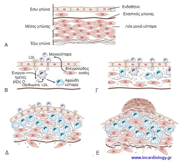 Σχηματισμός αθηρωματικής πλάκας στη στεφανιαία αρτηρία