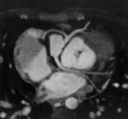 Έμφραγμα μυοκαρδίου με απόφραξη στεφανιαίας αρτηρίας