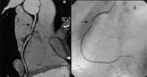 Εξέλιξη εμφράγματος στο μυοκάρδιο