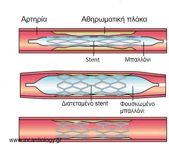 Τοποθέτηση stent σε στενωμένη στεφανιαία αρτηρία