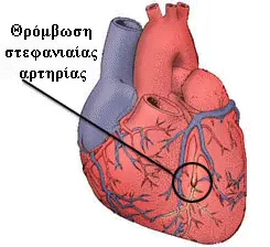 Θρόμβωση πάνω σε αθηρωματική πλάκα