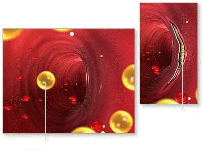 Ρήξη αθηρωματικής πλάκας και ενεργοποίηση θρόμβου