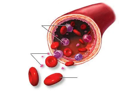 Ευάλωτη αθηρωματική πλάκα με λιπώδη πυρήνα
