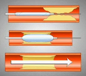 Απεικόνιση απλής αγγειοπλαστικής με μπαλονάκι