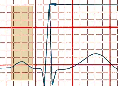 P wave ECG