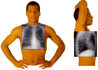 Chest X-Ray