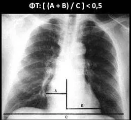 Cardiothoracic Ratio