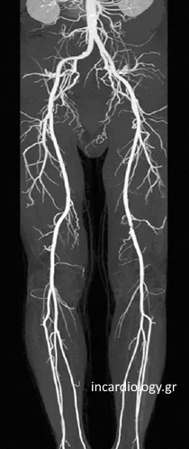 Angiography Imaging
