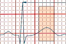 ECG T wave