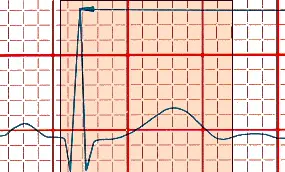 QT interval measurement
