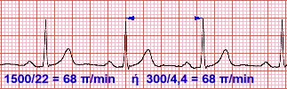 ECG HR calculation illustration