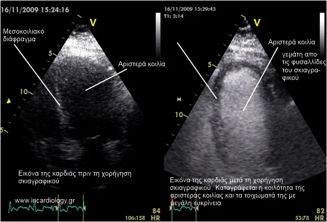 Contrast Echo Results