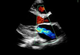 Color Doppler Heart