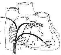 Electrophysiology Study