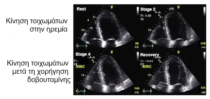 Stress Echo Procedure