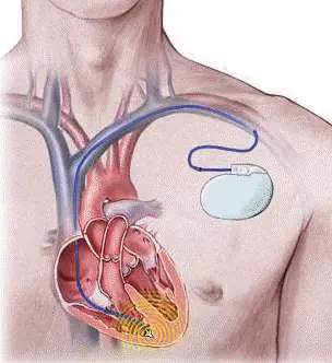 Απινιδωτής ICD