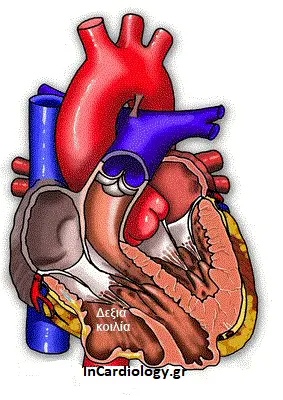 Αρρυθμιογόνος μυοκαρδιοπάθεια δεξιάς κοιλίας με διάταση και λιπώδη εκφύλιση