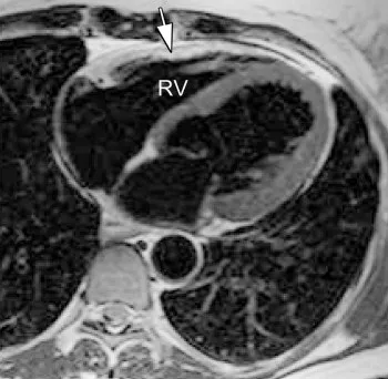 Μαγνητική τομογραφία με διάταση δεξιάς κοιλίας και λιπώδη διήθηση