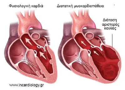 Διατατική μυοκαρδιοπάθεια με διάταση των κοιλιών