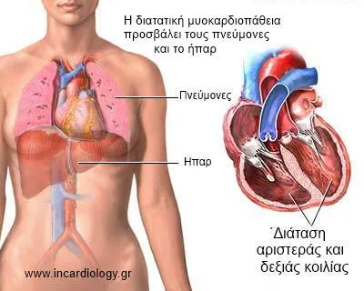Συμπτώματα διατατικής μυοκαρδιοπάθειας