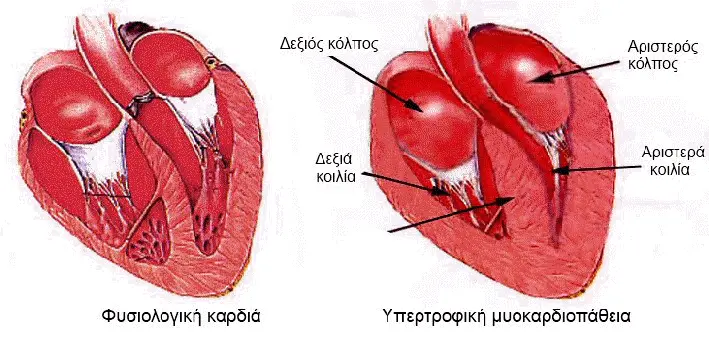 Υπερτροφική μυοκαρδιοπάθεια με πάχυνση του μεσοκοιλιακού διαφράγματος