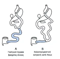 Γαστρική παράκαμψη Roux-en-Y