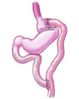 Γαστρικό by-pass βραχείας έλικας