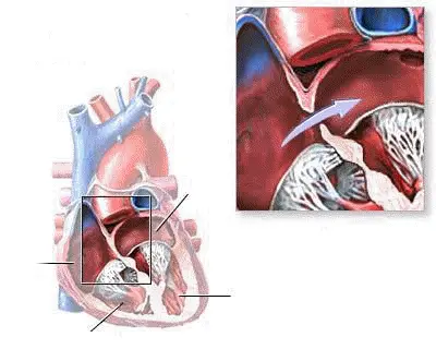 Μεσοκολπική επικοινωνία σε παιδικό φύσημα