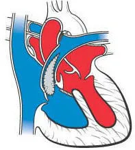 Χειρουργική επέμβαση Rastelli στην τετραλογία Fallot