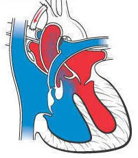 Χειρουργική επέμβαση Blalock-Taussig shunt